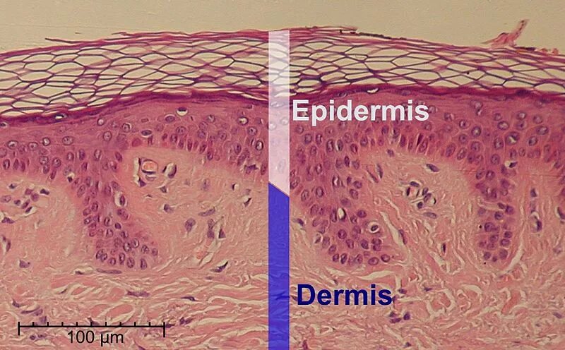 Эпидермис на лице как выглядит Skin Cancer Treatment NCI