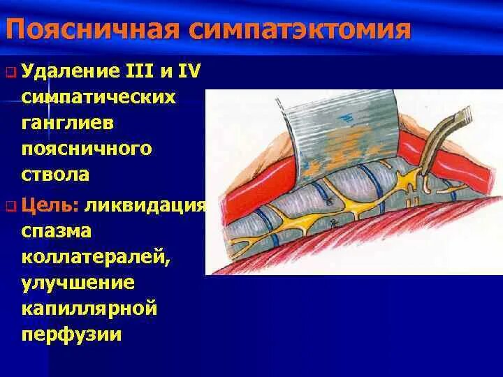 Симпатэктомия цена. Блокада симпатических ганглиев. Операция симпатэктомия. Поясничная симпатэктомия. Блокада поясничных симпатических ганглиев.