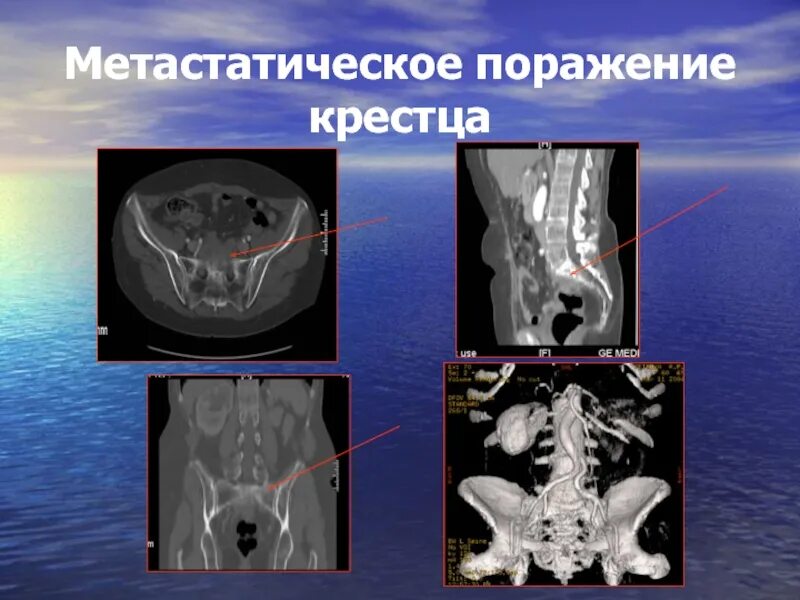 Метастатическое поражение кости. Метастатическое поражение. Образование крестца на кт. Объемное образование крестца.