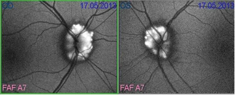 Друзы зрительного нерва аутофлуоресценция. Друзы диска зрительного нерва это. Друз зрительного нерва это.