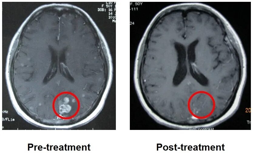 Рак мозга степени. Опухоль головного мозга метастазы. Метастатические опухоли мозга. Химиотерапия при метастазах в головном мозге.