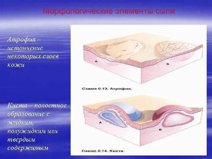Первичные полостные элементы. Морфологические элементы сыпи. вторичные морфологические элементы сыпи. полостные элементы сыпи. первичные морфологические элементы кожи.