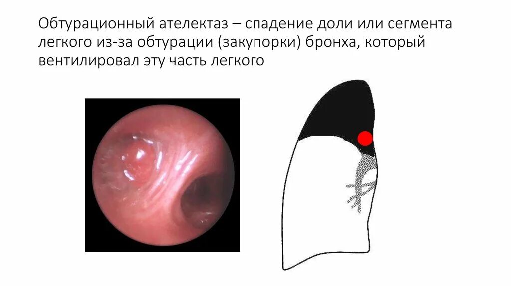 Обтурационный ателектаз легкого. Ателектаз бронхоскопия. Бронхоскопия при ателектазе. Ателектаз физикальное обследование. Обтурационный ателектаз.