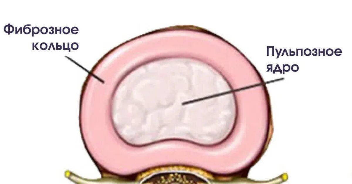 Содержимое межпозвоночного диска. Пульпозное ядро межпозвоночного диска. Пульпозное ядро и фиброзное кольцо. Пульпозное кольцо. Фиброзное кольцо межпозвоночного диска.