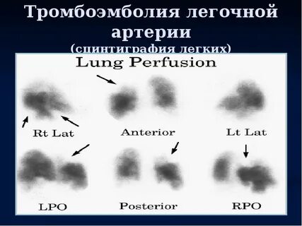 Тромбоэмболия легочной артерии тест