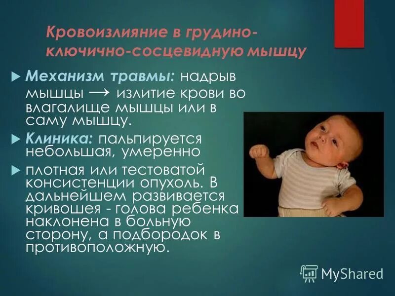 Недоношенный кровоизлияние. Родовая травма грудино ключично сосцевидной мышцы. Родовые травмы новорожденного. Родовые травмы презентация. Кровоизлияние в грудино-ключично-сосцевидную мышцу у новорожденных.