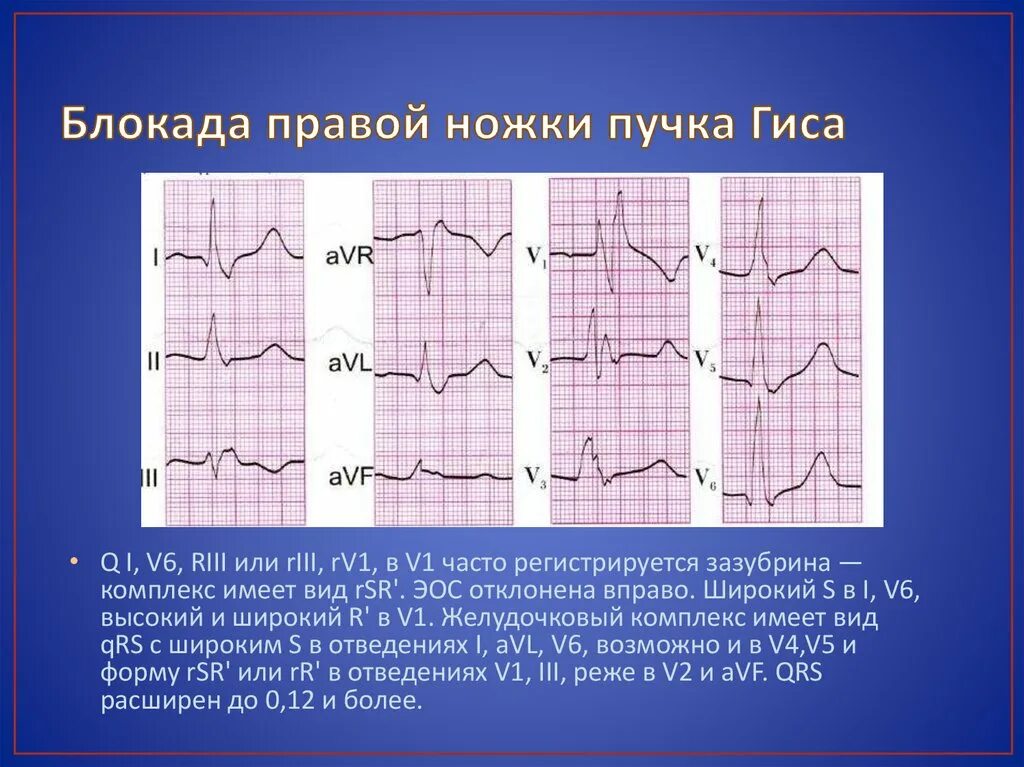 Неполная блокада ПНПГ на ЭКГ. ЭКГ признаки блокады ножек пучка Гиса. ЭКГ сердца при неполной блокаде правой ножки пучка Гиса. Блокада правой ножки пучка Гиса на ЭКГ.