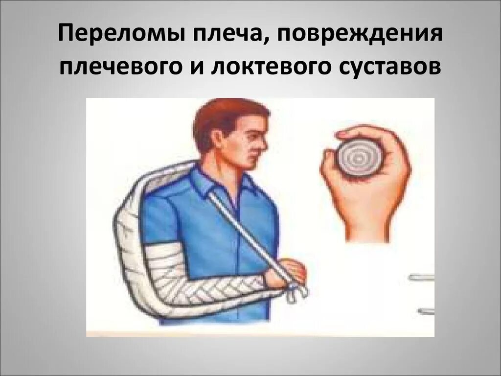 Перелом плеча помощь. При переломе плеча необходимо. перелом плеча первая помощь. перелом плечевого сустава пмп. перелом плечевого сустава первая помощь.