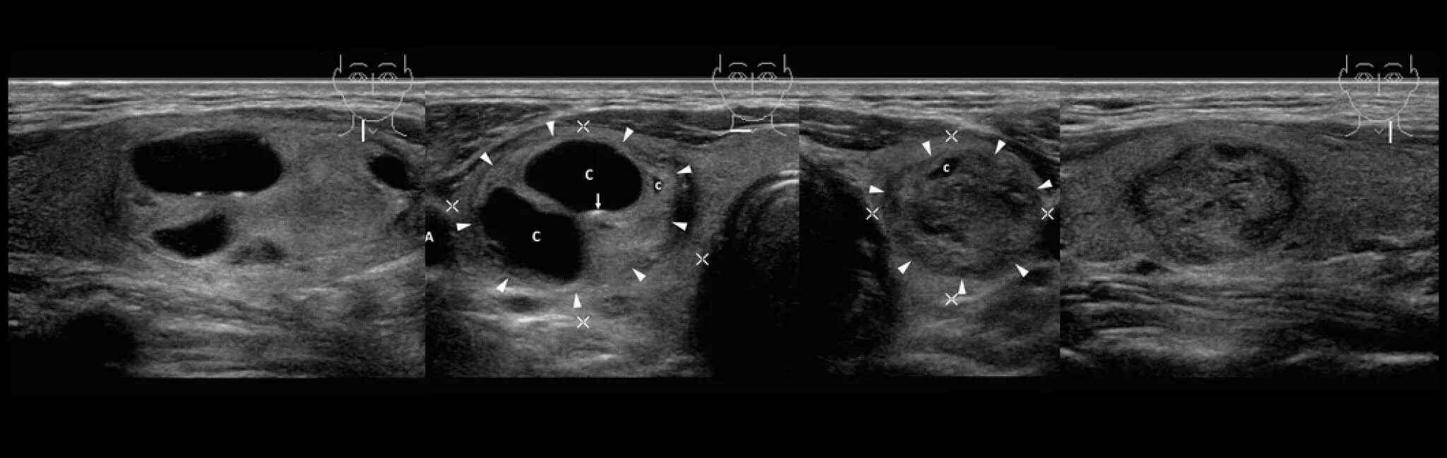 Многоузловой токсический зоб УЗИ. Коллоидный узел щитовидной железы на УЗИ. Токсический Узловой зоб на УЗИ. Узловой зоб щитовидной железы на УЗИ. Щитовидная железа изменения на узи
