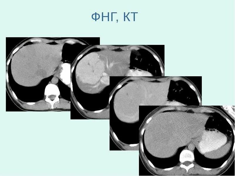 Нодулярная гиперплазия печени на кт. Фокальная гиперплазия печени кт. Очаговая Узловая гиперплазия печени кт. Фокальная нодулярная гиперплазия (ФНГ) печени кт.
