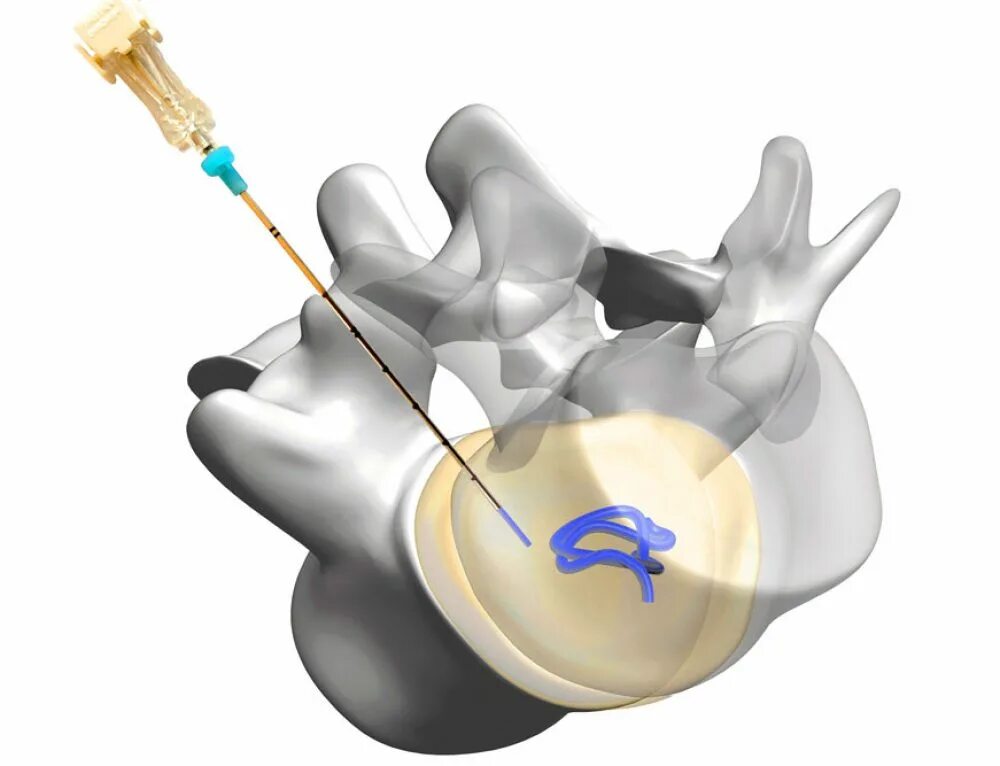 Нуклеопластика протрузии. Декомпрессионная нуклеопластика. Перкутанная нуклеопластика. Нуклеопластика холодная плазма. Восстановление формы и функции межпозвонкового диска.