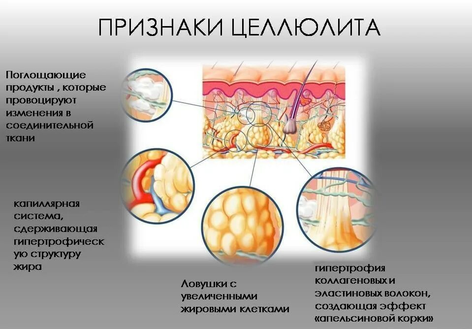 Почему появляется жир. Целлюлит строение жировой ткани. Строение жировой ткани женщины. Целлюлит механизм образования.