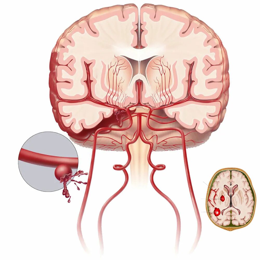 Субарахноидальное межполушарное кровоизлияние. Субарахноидальное кровоизлияние головного мозга пространство. Субарахноидальное кровоизлияние межполушарной щели. Субарахноидальные кровоизлияния (Сак).