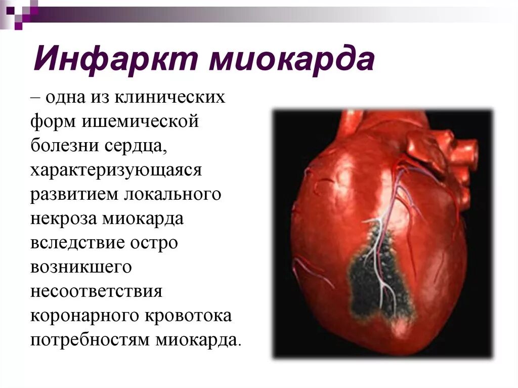 Больные с инфарктом миокарда. Инфаркт миокарда презентация. Ишемия инфаркт миокарда.