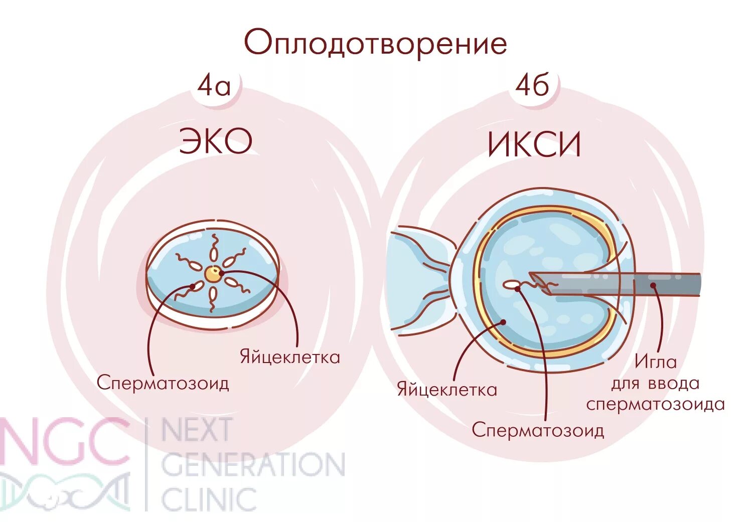 Инъекция сперматозоида в цитоплазму ооцита. Оплодотворение яйцеклетки ИКСИ. ИКСИ оплодотворение что это. Инъекция сперматозоида в цитоплазму клетки (ИКСИ)..
