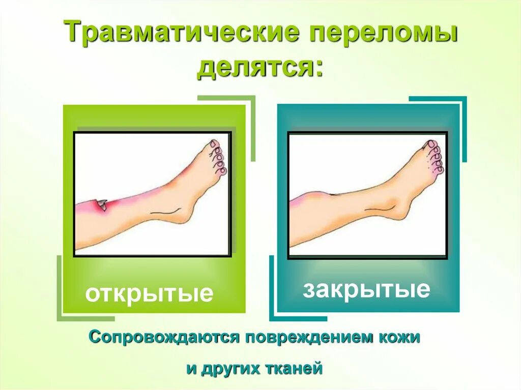 Закрытый перелом это. Травматические переломы. травма открытый перелом. травматический закрытый перелом.