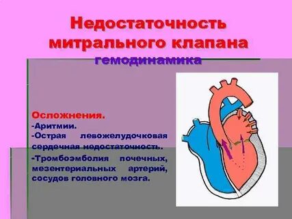 Недостаточность митрального клапана гемодинамика