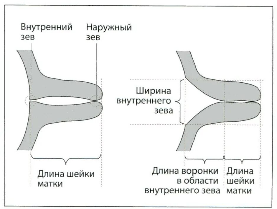 Длина шейки в 20 недель. Измерение длины шейки матки схема. Норма толщины шейки матки при беременности. Шейка матки Размеры норма при беременности. Ширина цервикального канала 2 мм.