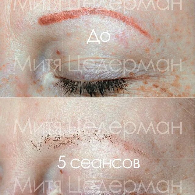 Красные брови после удаления татуажа. Цветокоррекция татуажа бровей лазером. Розовые брови после татуажа. Красные брови после перманентного макияжа. Красные брови после удаления татуажа.