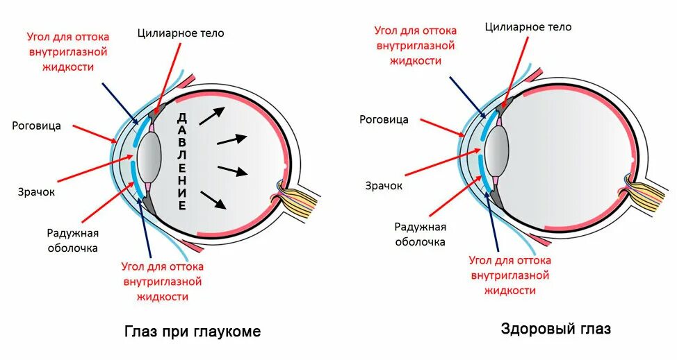 Можно вернуть зрение при глаукоме. Патогенез первичной открытоугольной глаукомы. Глаукома схема глаза. Строение глаза при глаукоме. Механизм развития глаукомы.