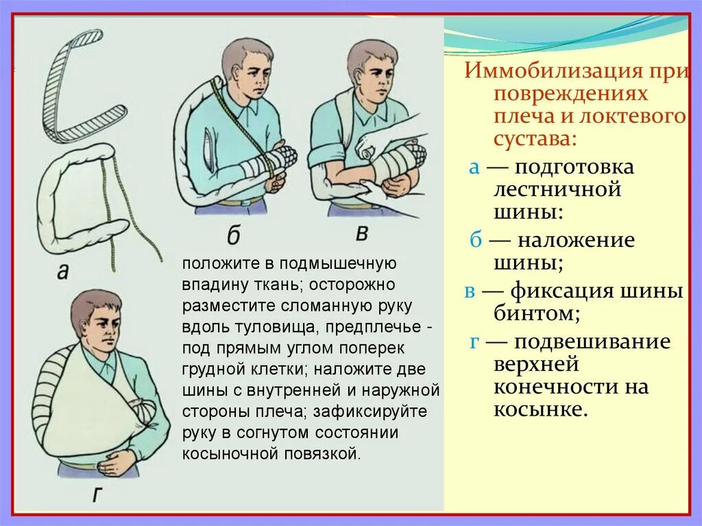 Иммобилизация плеча лестничной шиной. Транспортная иммобилизация при вывихе. Оказание первой помощи при травме плечевого сустава. Иммобилизация при вывихе плеча.