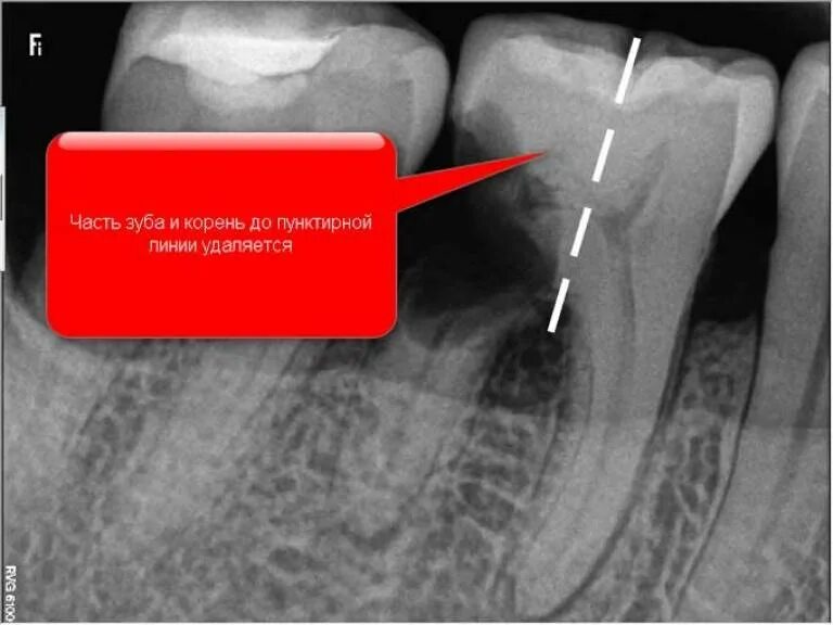 Трещина заднего зажила. Корневая (радикулярная) киста. Гемисекция многокорневого зуба.
