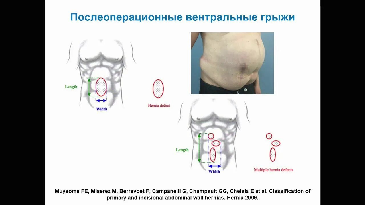 После грыжи сколько кг можно поднимать