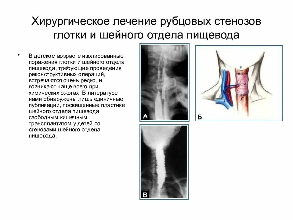 Сужение пищевода причины