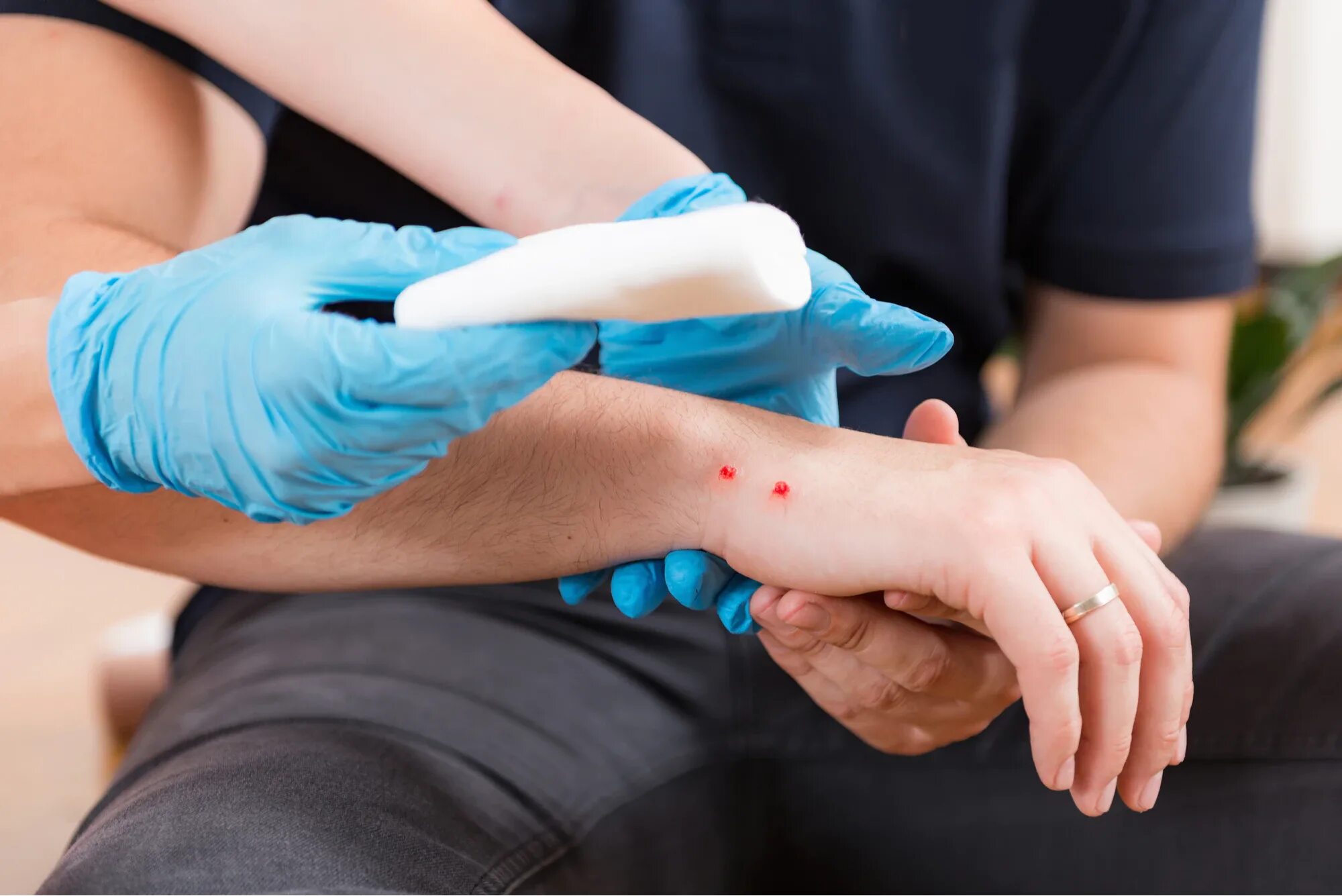 Snake bites. Snake bites
