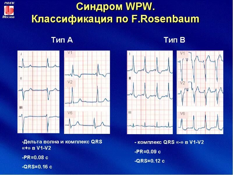 Синдром wpw на кардиограмме. Впв тип а на экг. Wpw синдром экг признаки. Синдром wpw тип а на экг. Феномен wpw типы.