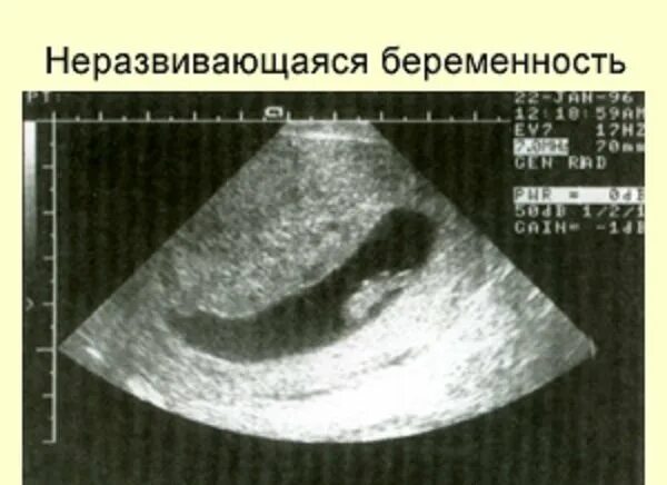 Как быстро замирает беременность. Неразвивающаяся беременность УЗИ. Признаки замершей беременности на УЗИ. Неразвивающаяся беременность 7 недель УЗИ. Неразвивающаяся беременность на ранних сроках УЗИ.