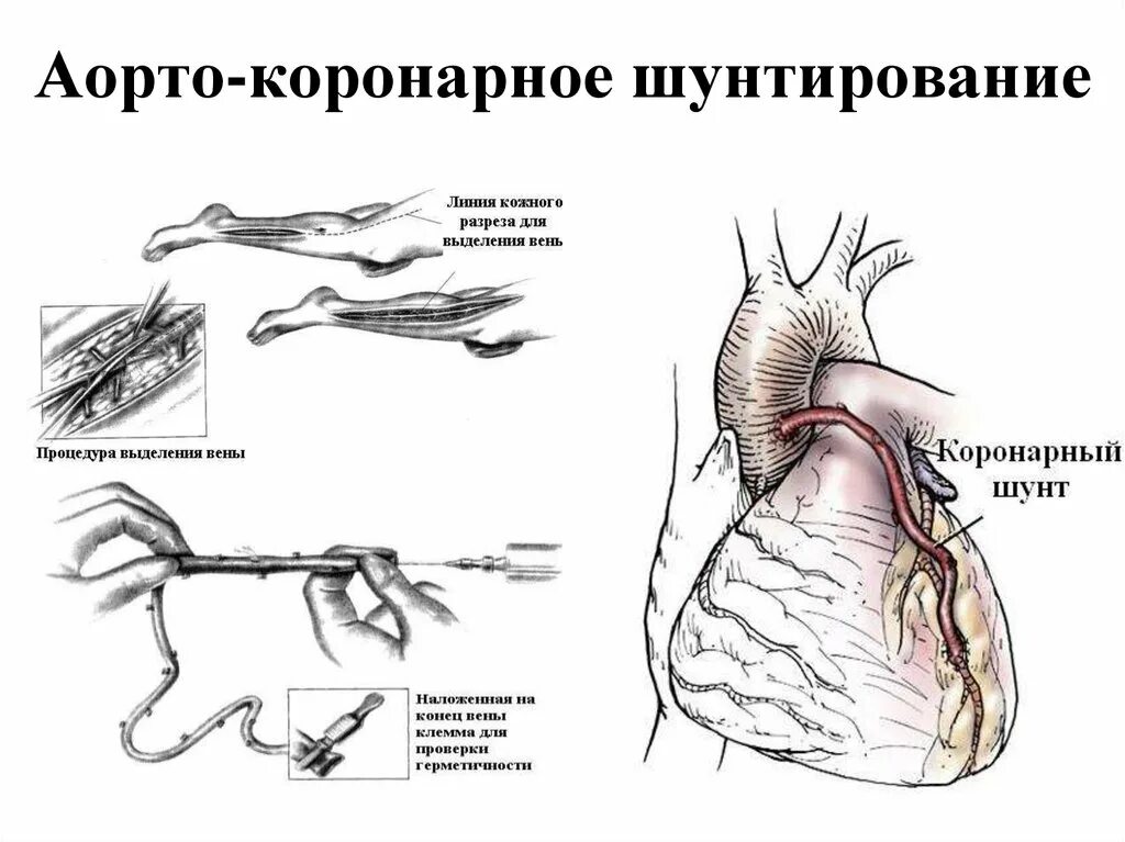 Операция коронарных сосудов. Схема операции аортокоронарного шунтирования. Коронарное шунтирование сосудов сердца. Аортокоронарное шунтирование топографическая анатомия. Шунтирование коронарных артерий схема.