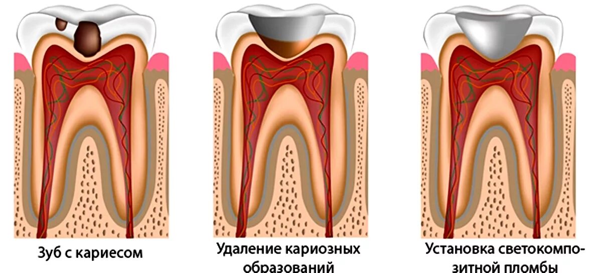 При каком кариесе удаляют зуб