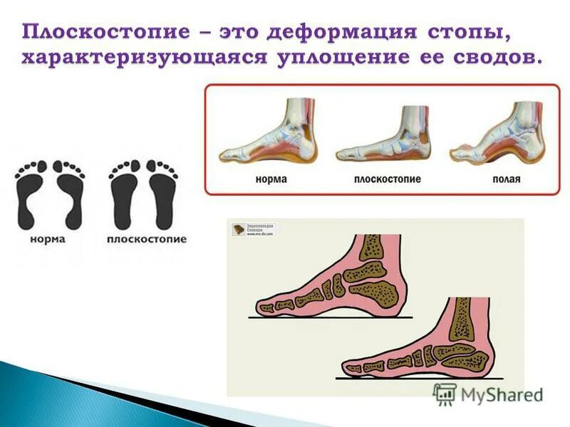 плоскостопие причины и профилактика. презентация плоскостопие 8 класс. презентация на тему плоскостопие. в пятых правило. что может привести к искривлению позвоночника и плоскостопия.