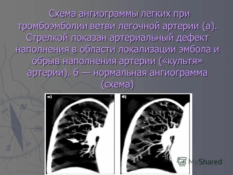 Тромбоэмболия легких прогноз