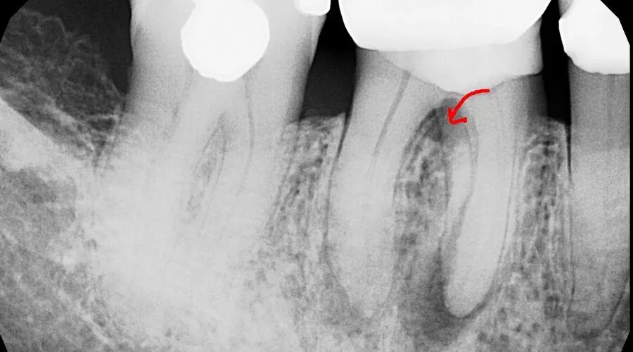 Воспаление канала зуба. Межкорневая гранулема. Перфорация корня зуба на снимке. Перфорация корня зуба на рентгеновском снимке. Перфорация дна полости зуба рентген.