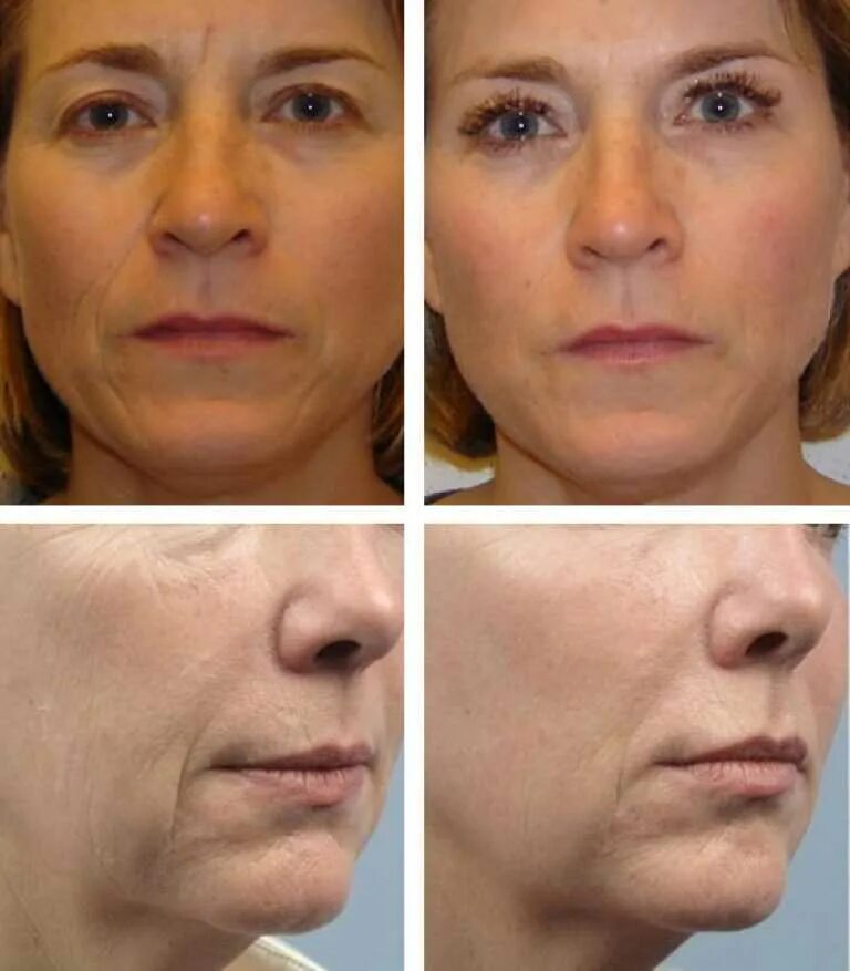 Инъекции в лицо. Филлеры для лица. Биоревитализация с дмае препараты. Уколы гиалуроновой кислоты до и после. Биоревитализация лица до и после эффект.