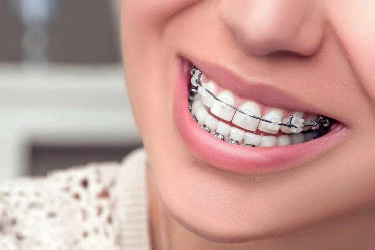Brackets photo. Brackets photo