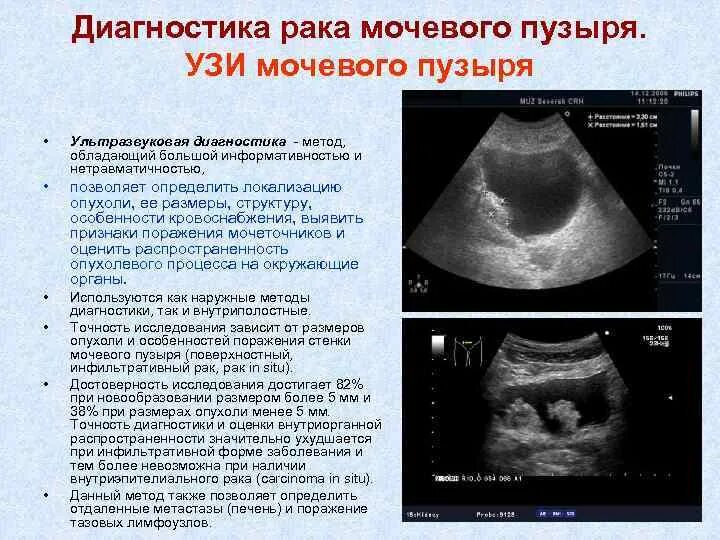 Как быстро наполнить мочевой пузырь. Объемное образование мочевого пузыря на УЗИ. УЗИ мочевого пузыря расшифровка. УЗИ мочевого пузыря норма. Тампонада мочевого пузыря на УЗИ.