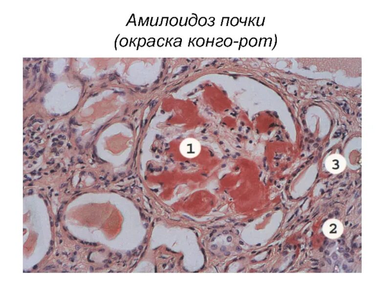 Амилоидоз почки (окраска Конго-красным и гематоксилином). Амилоидоз почек окраска Конго красный. Амилоидоз почки микропрепарат Конго красный. Амилоидоз почки Конго красный гистология. Пиелонефрит микропрепарат