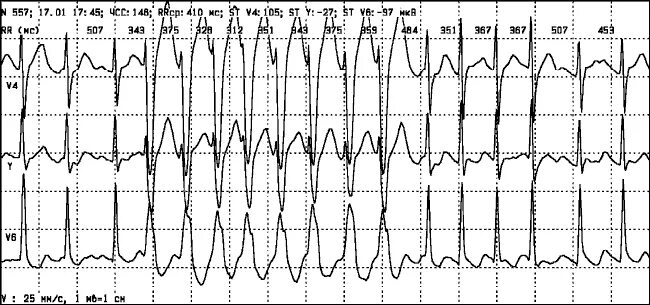 Холтеровское мониторирование при мерцательной аритмии. Холтер фибрилляция предсердий заключение экг. Фибрилляция предсердий хм экг. Желудочковая тахикардия на холтере. Фибрилляция предсердий на холтеровском мониторировании.