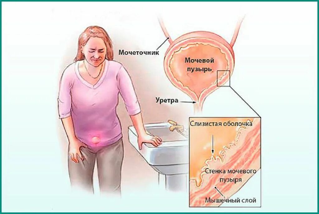 Можно греть мочевой. Интерстициальный цистит. Цистит у женщин.