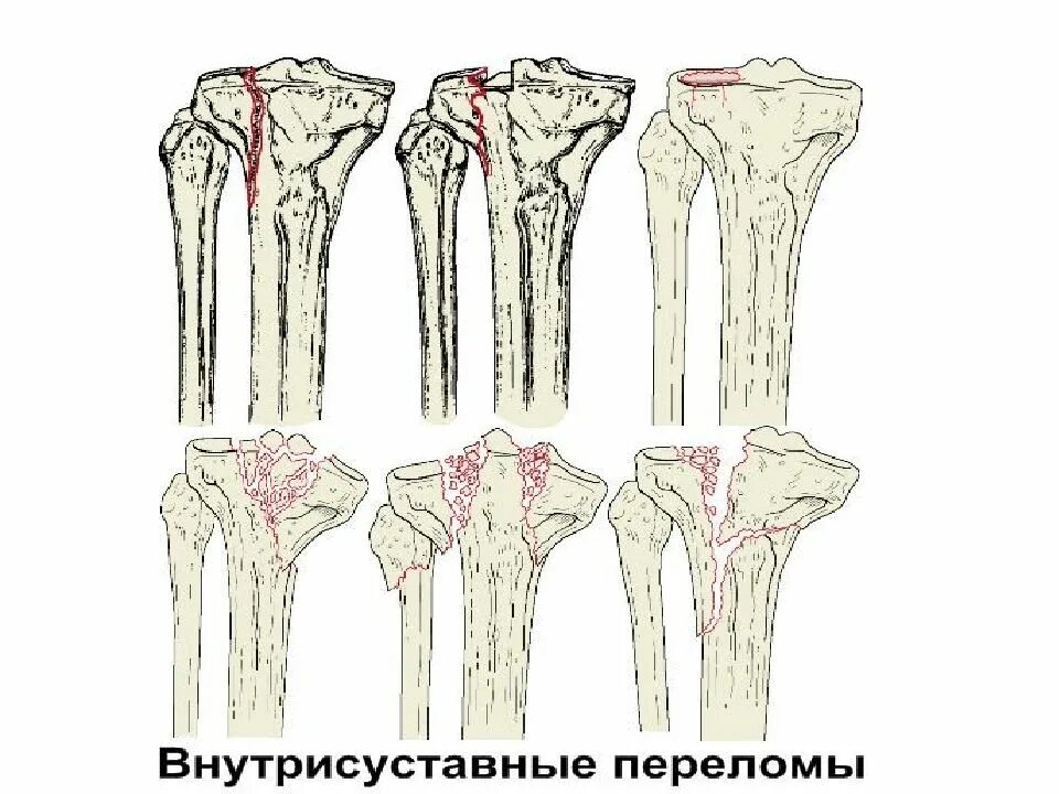 Как лечить большеберцовую кость