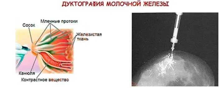 Изменения кожи молочной железы. Боль в мышцах грудной клетки. Уплотнение грудной железы. Правильное прикладывание к груди новорожденного. Маммограмма доброкачественных опухолей.
