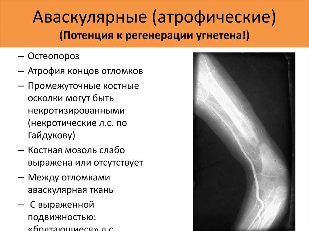 Атрофический ложный сустав. Несросшийся перелом и ложный сустав. Атрофическая регенерация.