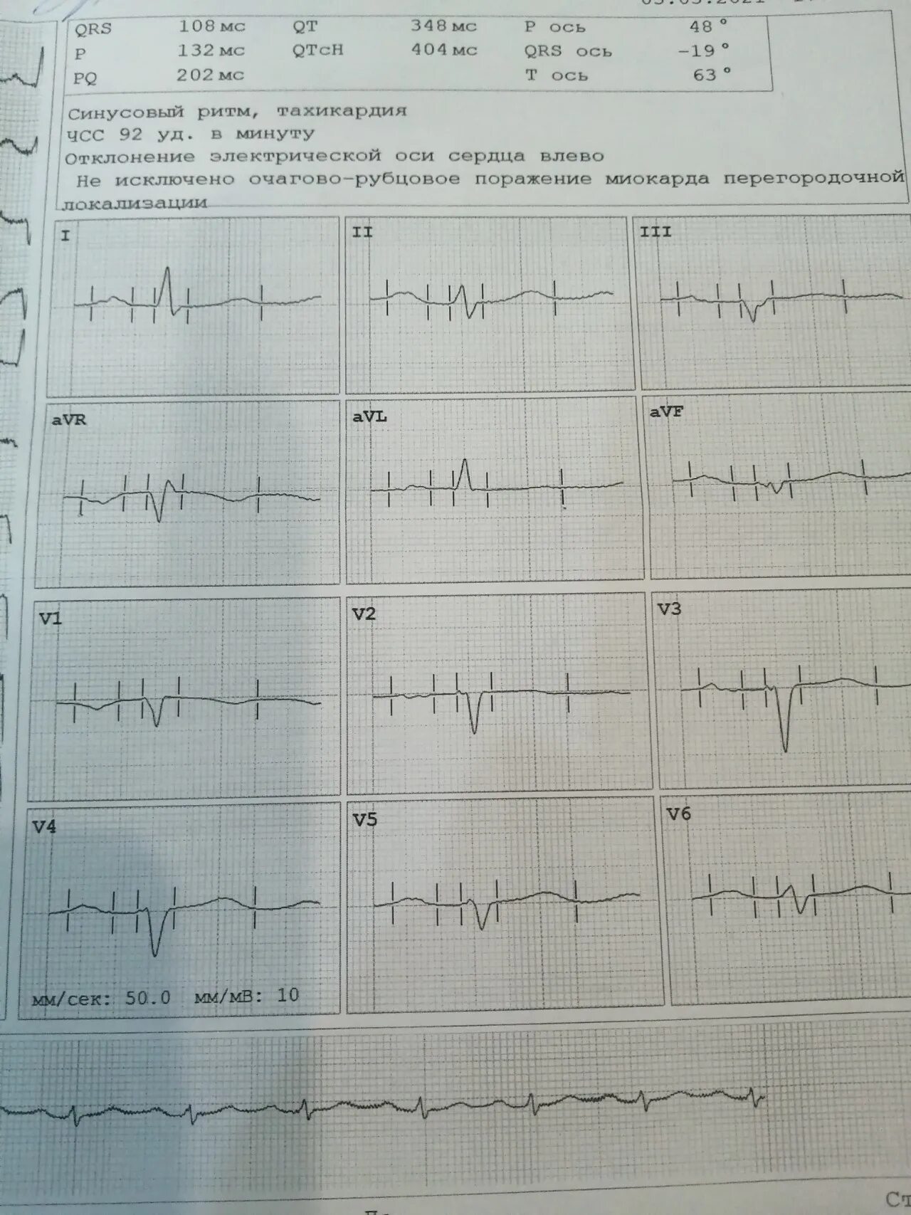 Диффузные изменения экг что это значит. Очаговые изменения миокарда на ЭКГ. Диффузные изменения миокарда на ЭКГ. ЭКГ при инфаркте. Диффузные изменениев миокарде на ЭКГ.