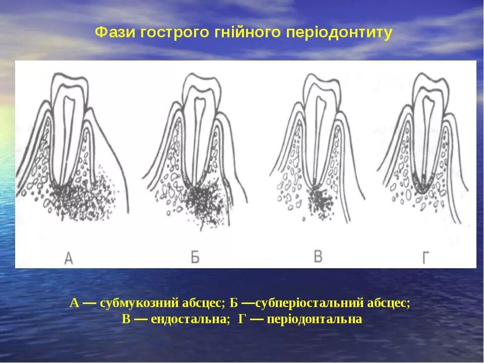 Рокс периодонт. Острый гнойный периодонтит. одонтогенный периодонтит. травматический апикальный периодонтит. факторы инфицирования периодонта зуба.