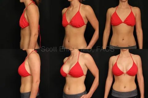 ...an exciting technique available known as Transaxillary Breast Augmentati...