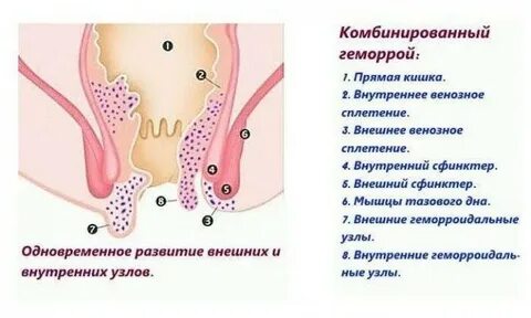 К основным клиническим симптомам хронического геморроя относятся