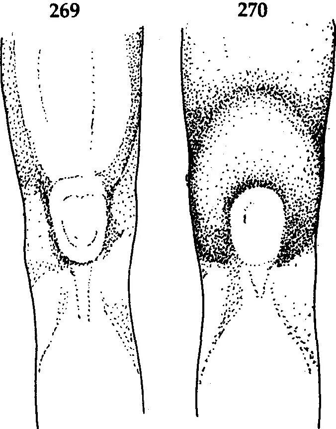 Болезнь осгуда шлаттера мрт. Сумки коленного сустава на кт. Полости суставов с небольшим выпотом что это. Строение сустава суставная полость. Суставной выпот коленного сустава.